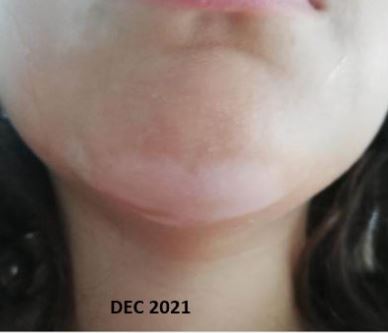 Vitiligo in children - before