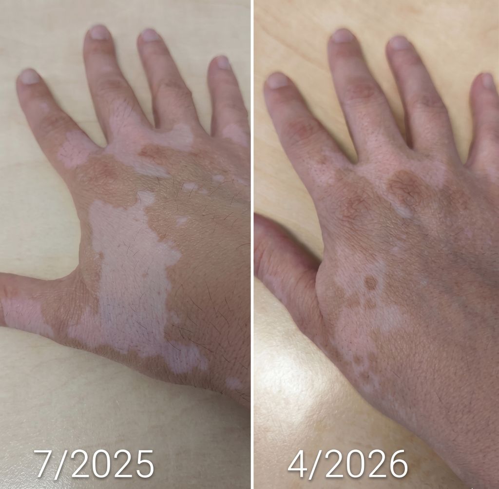 Vitistop Gel and light treatment results on hands