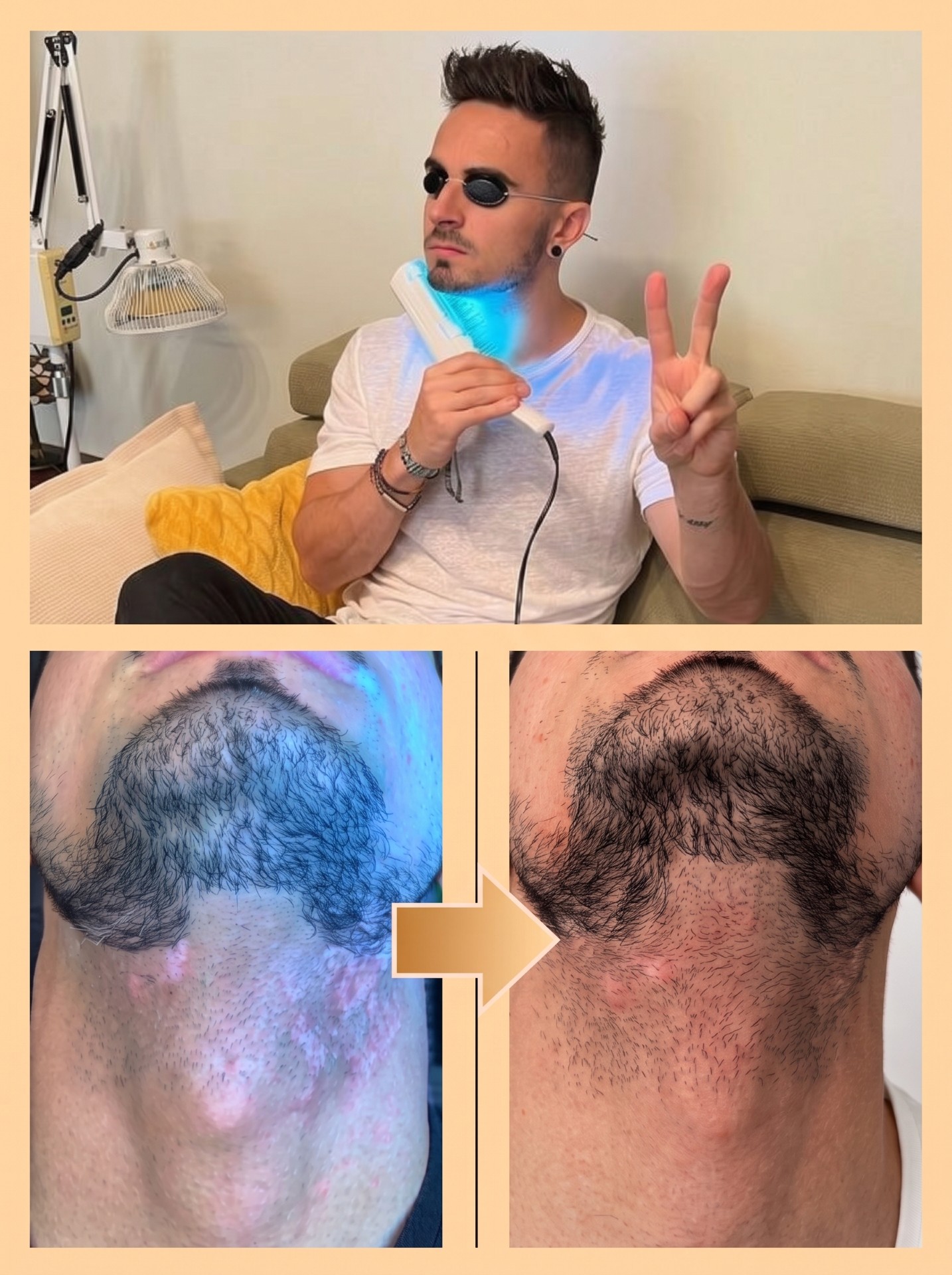 Vitiligo UVB phototherapy result