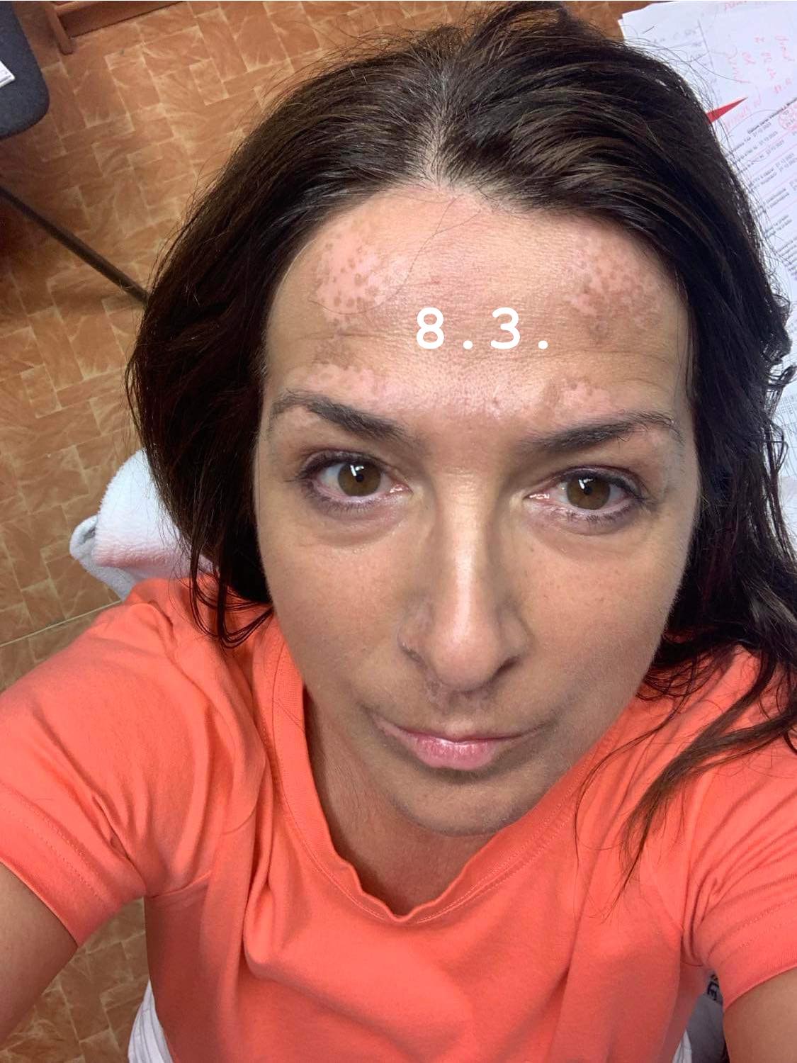 Adriana vitiligo progress 2