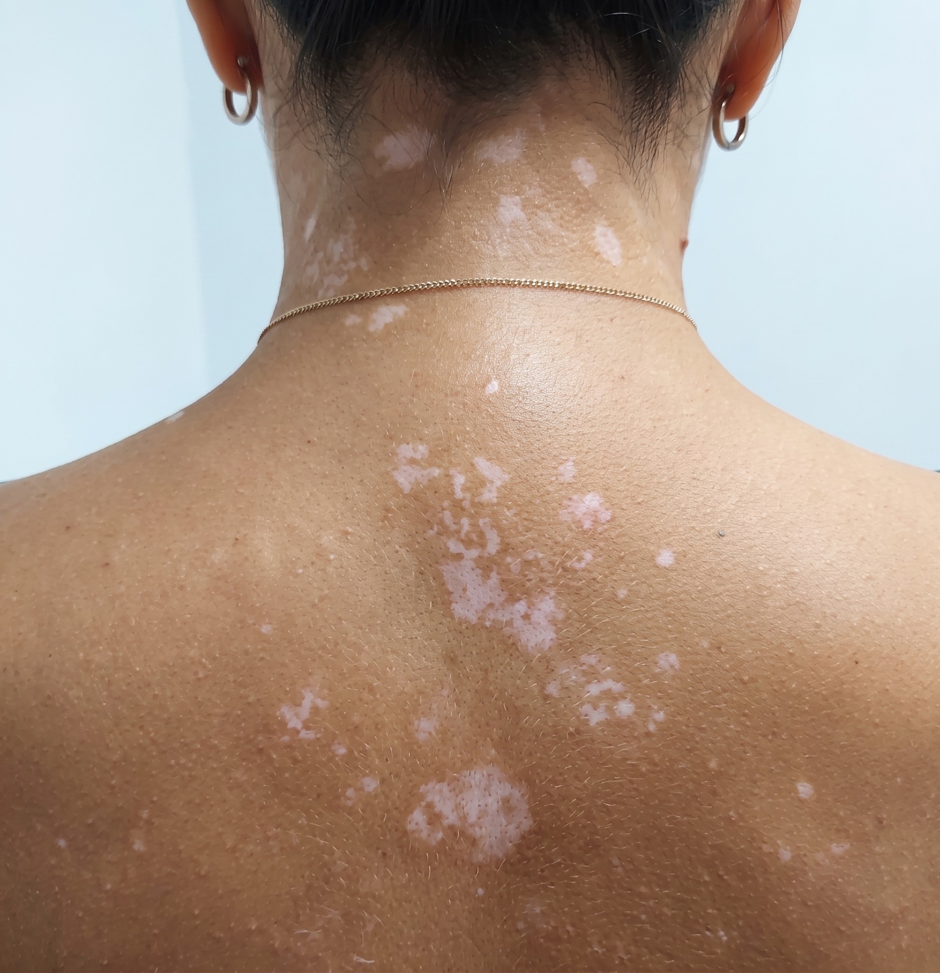 Andy's back showing vitiligo repigmentation after treatment with Vitistop Gel and UVB lamp