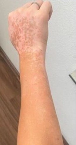 Julia - After Treatment