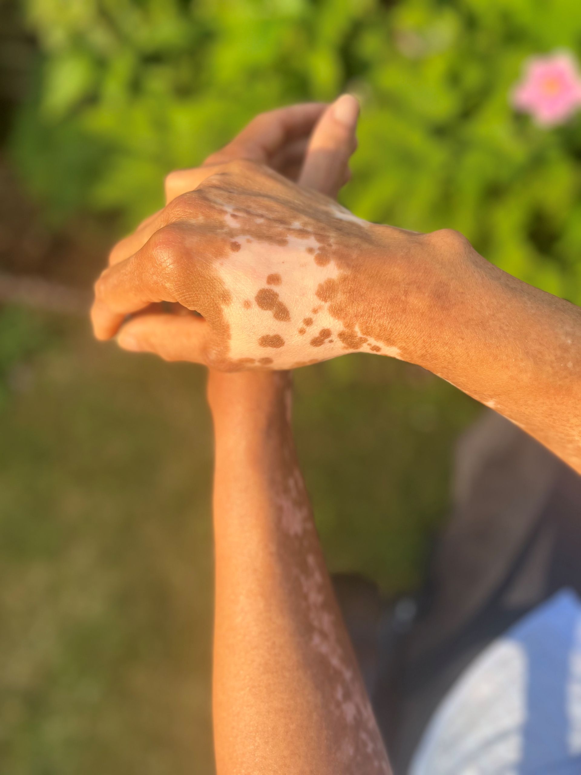 Norma's hands showing repigmentation progress after treatment