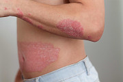 psoriasis phototherapy