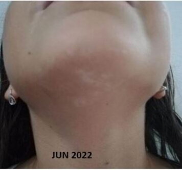 Vitiligo in children - after