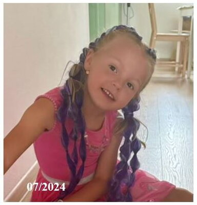 Vitiligo in children - after