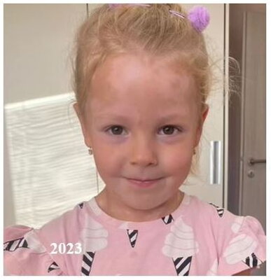 Vitiligo in children - before