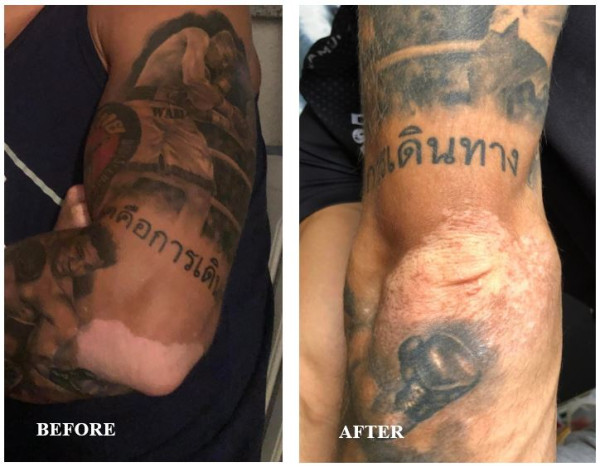 Elbow showing vitiligo repigmentation