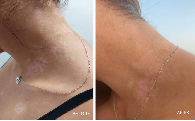 Vitistop Gel before and after