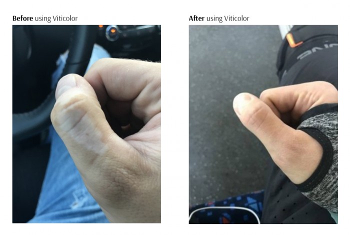 Before and after using Viticolor