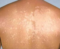 Other pigmentary disorders of the skin