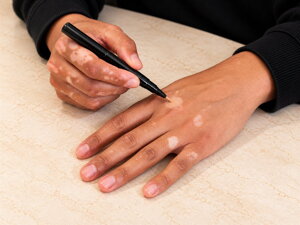 Cosmetic camouflage products to cover vitiligo patches