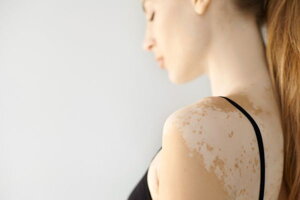 Vitiligo creams and skincare products to support repigmentation
