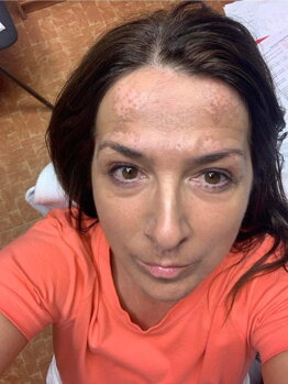 Adriana's face with vitiligo patches after one month of treatment, early signs of change