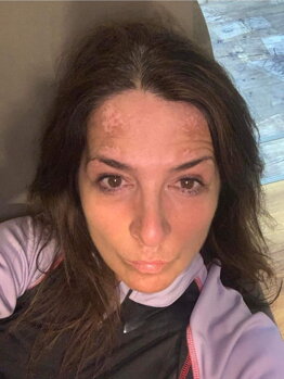 Adriana's scalp showing vitiligo repigmentation progress after two months of treatment