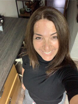 Adriana's face with visible partial repigmentation of vitiligo patches after three months