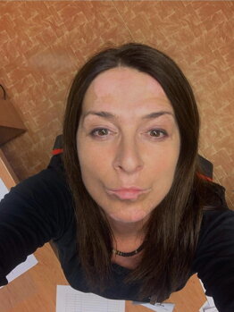 Adriana's face showing vitiligo patches before starting treatment