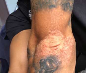 Andrew's arms showing repigmentation after Vitistop Gel treatment