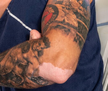 Vitiligo patches on Andrew's arms before treatment