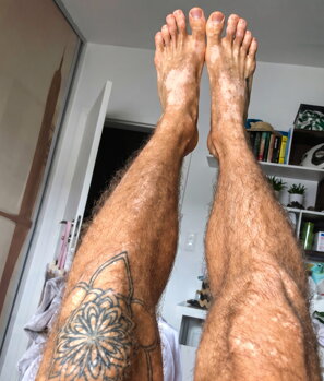Andrew's legs showing repigmentation after Vitistop Gel treatment