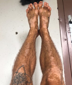 Vitiligo patches on Andrew's legs before treatment