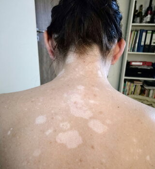 Vitiligo patches on Andy's back before treatment