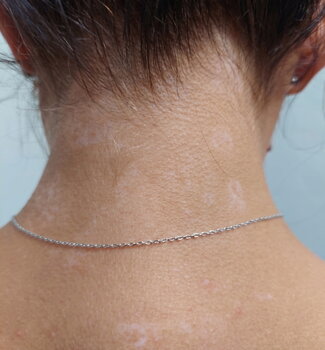 Andy's neck showing repigmentation after Vitistop Gel and UVB treatment