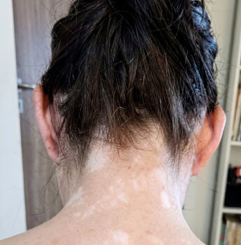 Vitiligo patches on Andy's neck before treatment