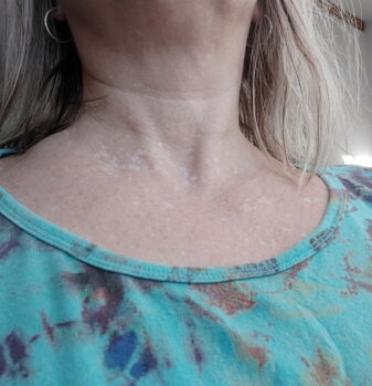 Jana's neck showing repigmentation after 4 months of treatment