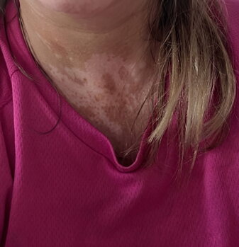 Vitiligo patches on Jana's neck before treatment