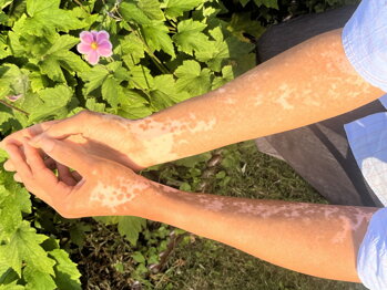 Repigmentation progress on Norma's arms