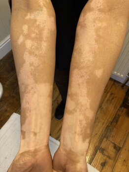 Vitiligo on Norma's arms before treatment