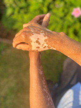 Repigmentation progress on Norma's hands