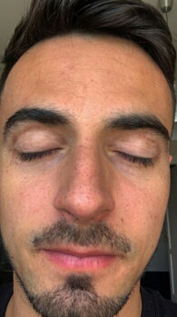 Peter's face showing repigmentation after 8 months of treatment