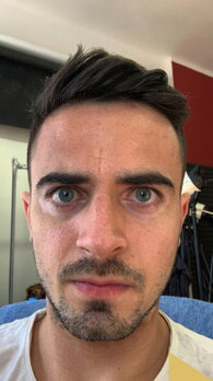 Vitiligo patches on Peter's face before treatment