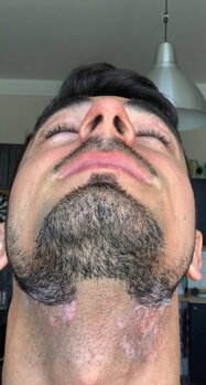 Vitiligo patches on Peter's neck before treatment