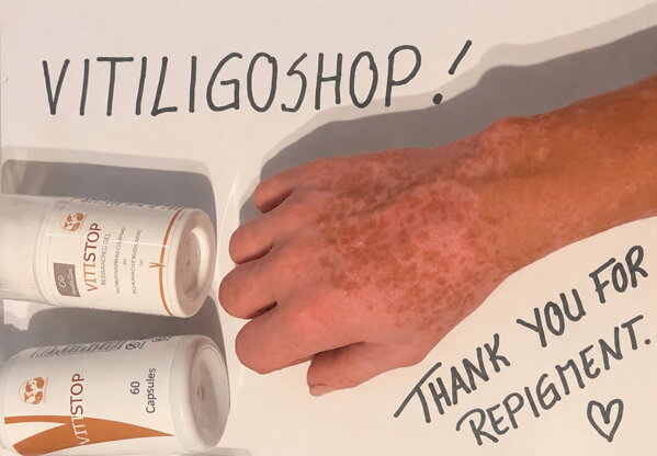 Vitiligo on fingers