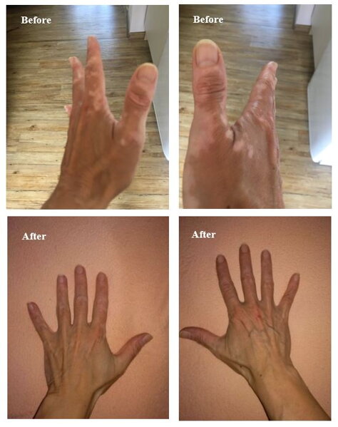 Vitiligo on hands before and after