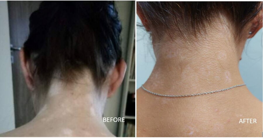 Vitiligo on the back of the neck before and after – Andy H., VitiligoShop