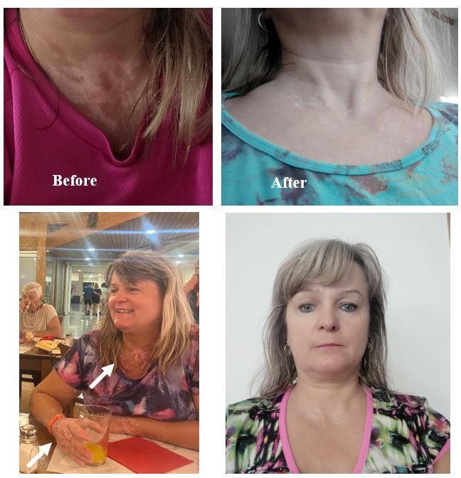Vitiligo on the neck and upper chest – Jane V., VitiligoShop customer