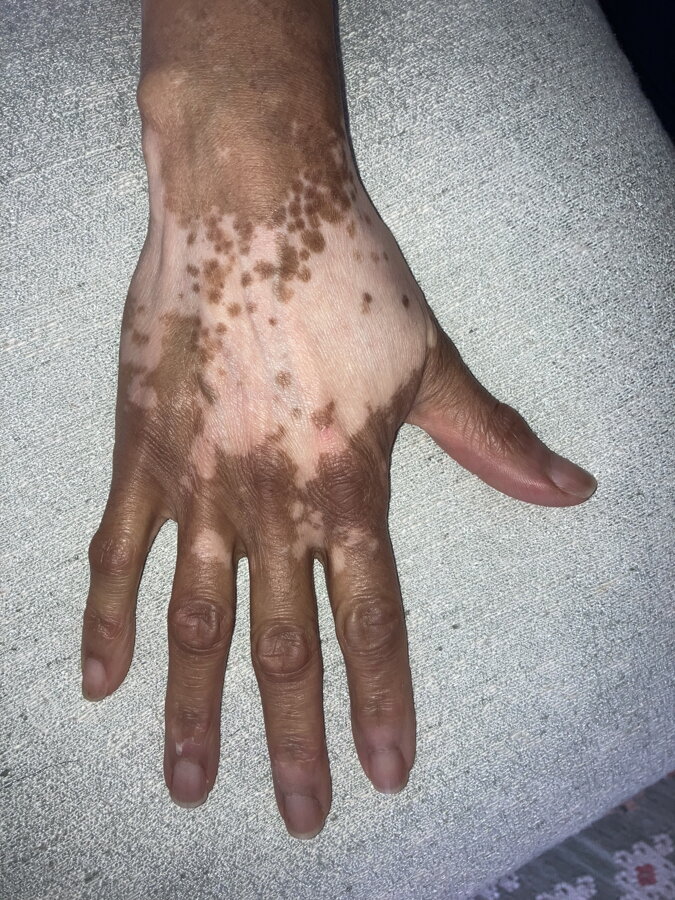 Pigment islands on the back of the hand – Norma, VitiligoShop customer