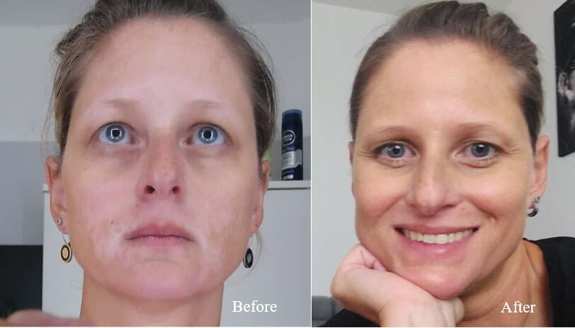 Vitiligo on the face before and after – Charlotte, VitiligoShop customer