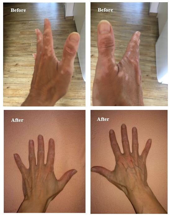 Vitiligo on hands before and after – Sophie, VitiligoShop customer