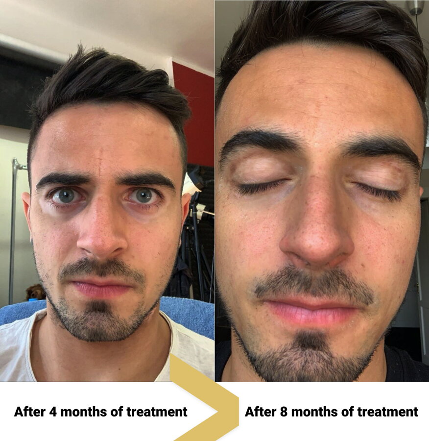 Facial vitiligo after 4 and 8 months – Peter, VitiligoShop customer