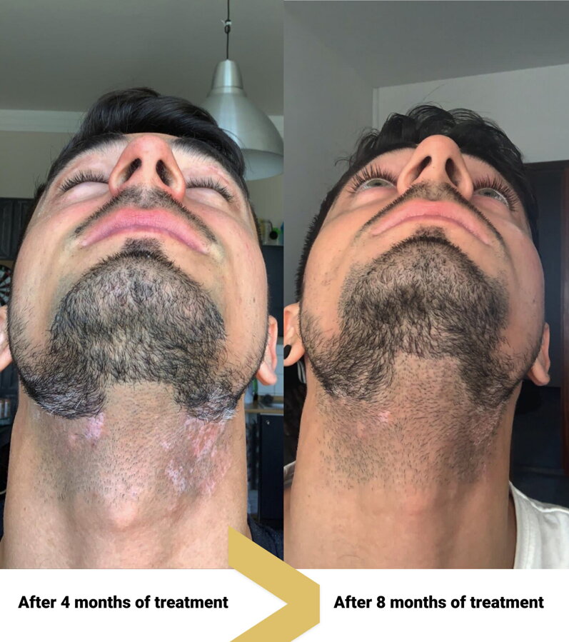 Vitiligo on the neck before and after – Peter, VitiligoShop customer